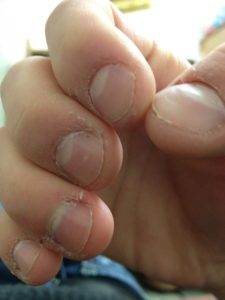 Use Of Vaseline To Repair Dry Cuticles