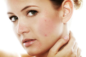 Treatment Of Acne Is One Of The Amazing Benefits Of Turmeric For Skin