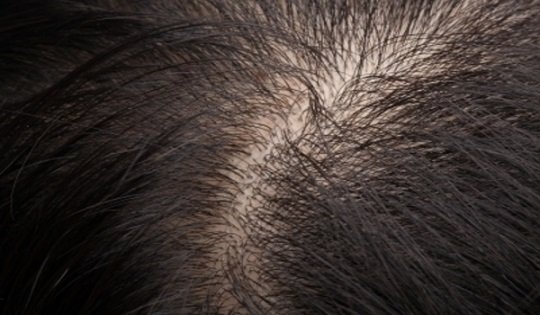 Treat Hair Thinning With Effective Home Remedies